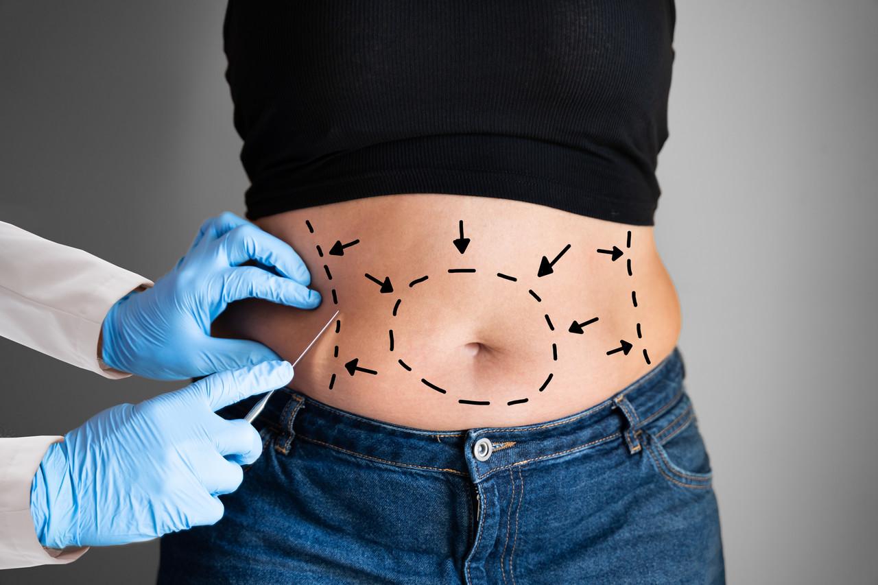 Abdominoplasty (Tummy Tuck)